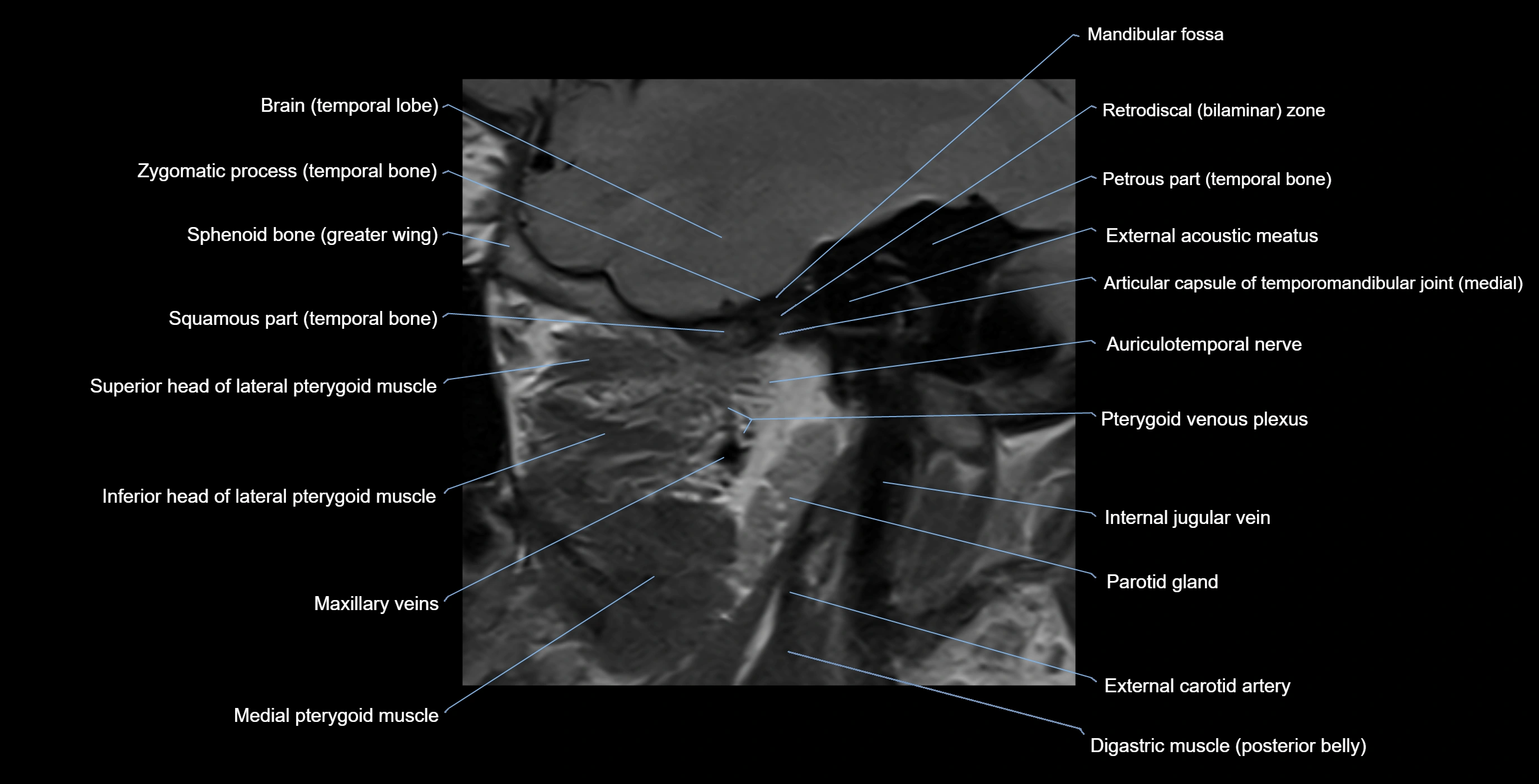 MRI TMJ sagittalclosed  mouth cross sectional 3T anatomy -img-00001-00014.webp